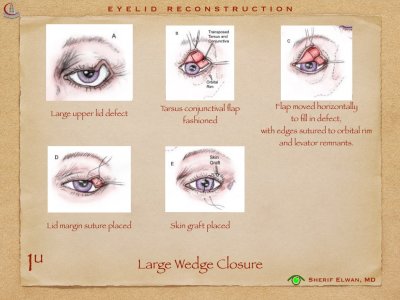 Eyelid Reconstruction.013.jpeg