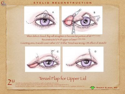 Eyelid Reconstruction.014.jpeg