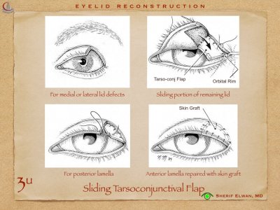 Eyelid Reconstruction.015.jpeg