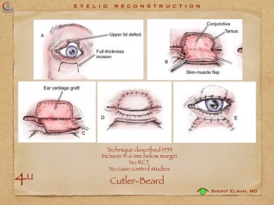 Eyelid Reconstruction.016.jpeg