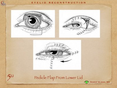 Eyelid Reconstruction.017.jpeg
