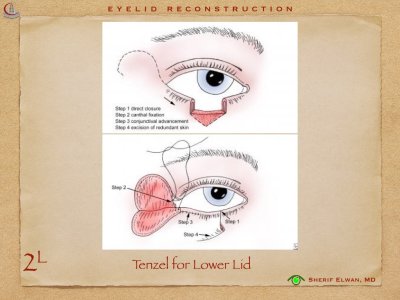 Eyelid Reconstruction.020.jpeg