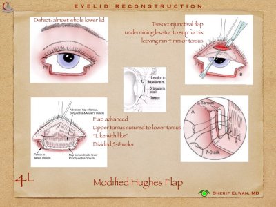 Eyelid Reconstruction.022.jpeg