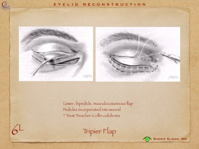 Eyelid Reconstruction.028.jpeg