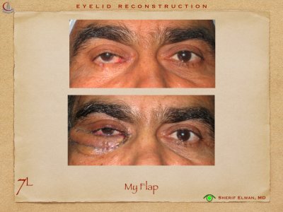 Eyelid Reconstruction.030.jpeg