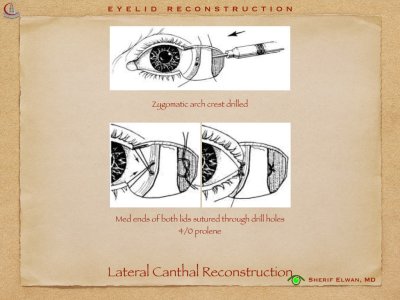 Eyelid Reconstruction.032.jpeg