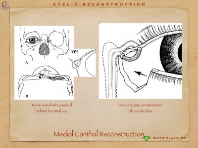 Eyelid Reconstruction.034.jpeg