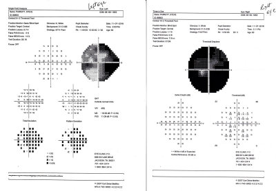 Field vision test results.