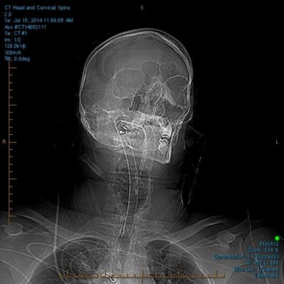 CT Head and Cervical Spine 0001.jpg