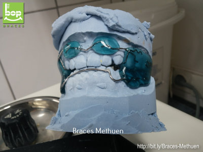 Braces Orthodontics Pediatrics- bop BRACES (M3) (CID) - 11.jpg