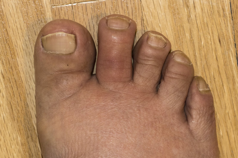 5/18/2021  My second toe on my right foot is swollen and sore.  Could it be Arthritis?