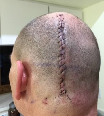 the scar from the first surgery 