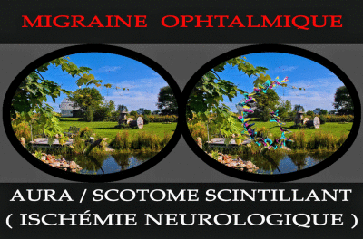 LA MIGRAINE ME LAISSE 100 MAUX . . .Dfinition de ce quest la sant par l'OMS (Organisation Mondiale de la Sant)
LOMS dfinit la sant comme un tat de bien tre physique, mental et social total
et non simplement comme une absence de maladie ou d'infirmit.
Les personnes atteintes de MIGRAINE CHRONIQUE, de AVF et autre ncessit n'ont plus accs  ce bien tre physique, mental et social tel que dfini prcdemment.
BONNE CHANCE !

Les personnes atteintes de MIGRAINE CHRONIQUE n'ont plus accs  une vie dites normale compte tenu des douleurs et contraintes qu'elle impose.
Chez certain migraineux s'ajoute  cela, lalgie vasculaire facial, et l leur compte est bon.

L'algie vasculaire de la face AVF (Cphale de Horton / Cluster Headache), tout comme la migraine, est une forme aigu de cphale. 
Il s'agit d'une affection rare, extrmement douloureuse et invalidante pour celui qui en souffre.

La mdecine estime qu'il s'agit de l'une des douleurs les plus intenses et qu'elle dpasse celle d'une amputation sans anesthsie.
On comprend alors qu'entre chaque crise, la moindre cphale ou migraine peut devenir angoissante et faire craindre le pire.

Plus d'info page suivante...

Liens : Sur la vido qui suit, la scne peut vous semble thtrale mais dtrompez-vous, c'est la triste et souffrante ralit. 
Les lamentations et gmissements sont ractionnels et incontrlables je peu vous l'affirmer :  http://www.youtube.com/watch?v=3IQ6s1no3Qg
