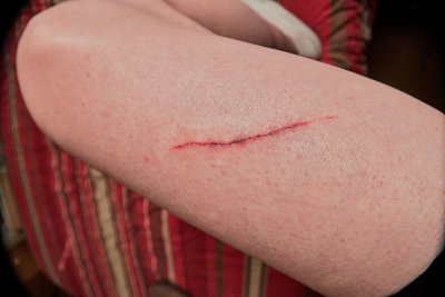 Accidental kitty scratch, in August 2018