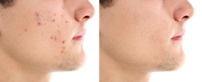 5 Suggestions To Remove Blackheads From Nose Permanently 