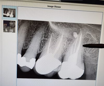 Root Canal Fix After Treatment