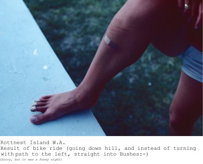 265 Rottnest Island - Carmel cycling damage (incl toes).jpg