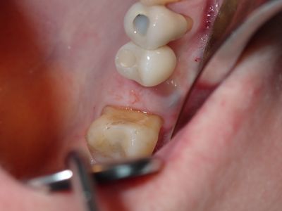 RYang - 26 implant removal and graft