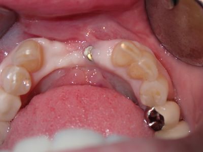 NSankhyan - 32 implant redo