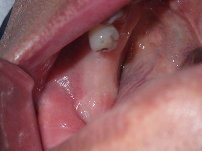TZeng - 36 implant