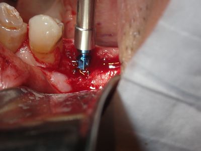 TZeng - 37 implant