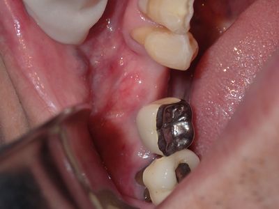 WYu - 35 implant