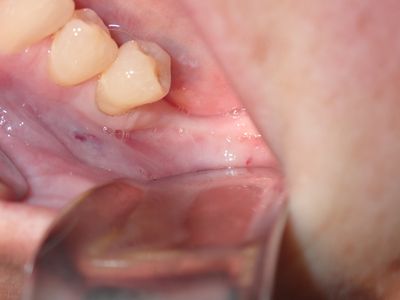 JGolos - llq bone graft