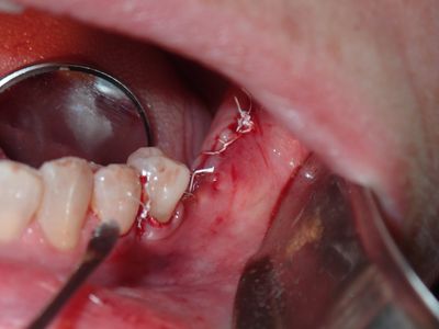 JGolos - llq bone graft