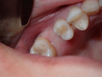 JChen - 16 implant