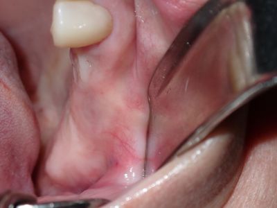 BTan - ulq - guided surgery