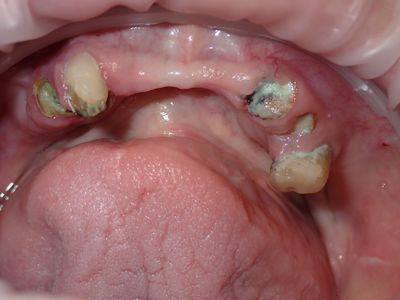 KPaterson - immediate lower arch - 2 implants