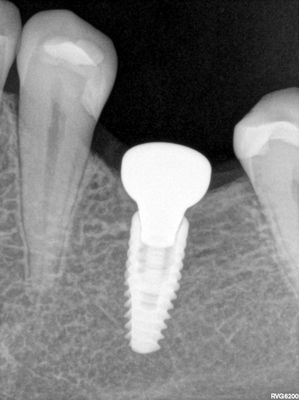 TZeng - 36 implant placement with bone expansion