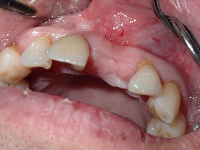 TZeng - 21 implant