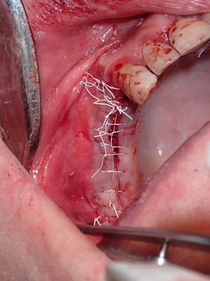 JGolos - R Sinus Augmentation