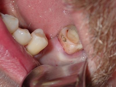 ARumiantsava- 36 implant - 37 exo