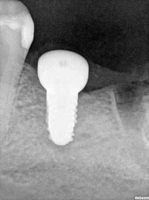 ARumiantsava- 36 implant - 37 exo