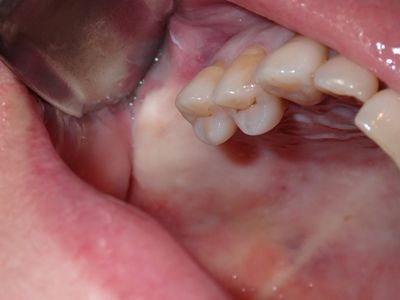 MKim - urq - bone graft