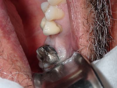 JLin - 26 implant -graft around existing 36 impl