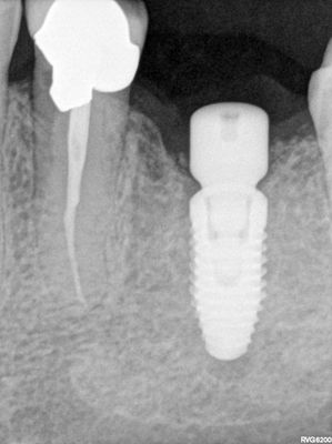 JLin - 26 implant -graft around existing 36 impl
