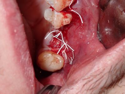 ARumiantsava - 27 socket graft