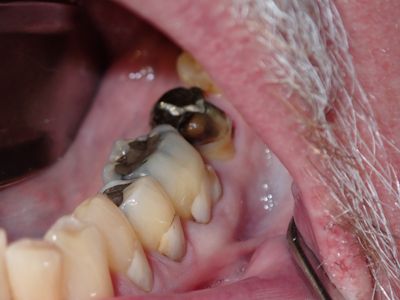 MLodhia - 37 socket graft 