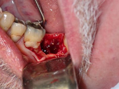 MLodhia - 37 socket graft