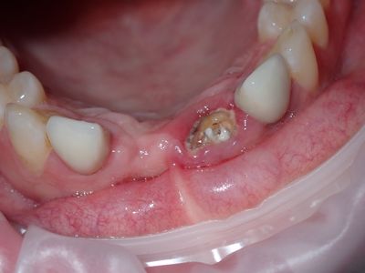 NSankhyan - immedaite 11 and 21 implant