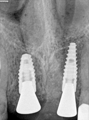 NSankhyan - immedaite 11 and 21 implant