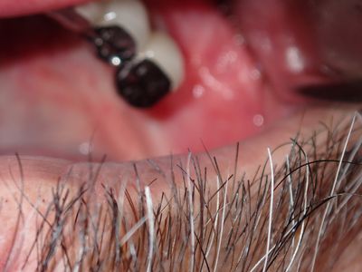 JLin - 46 implant