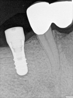JLin - 46 implant
