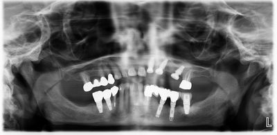 MLodhia -ulq implants