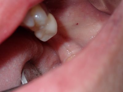 JGolos - lrq implants