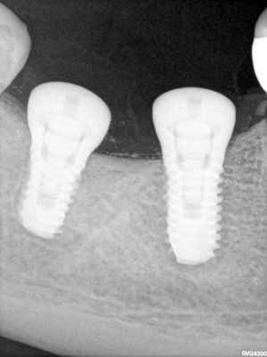 JGolos - lrq implants