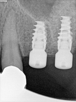 MWang - ulq - CAS-lift and implant placement